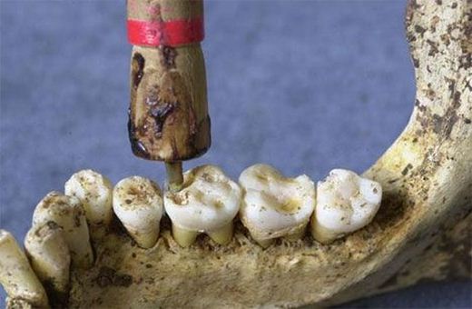 alatan doktor gigi pada zaman dahulu 12